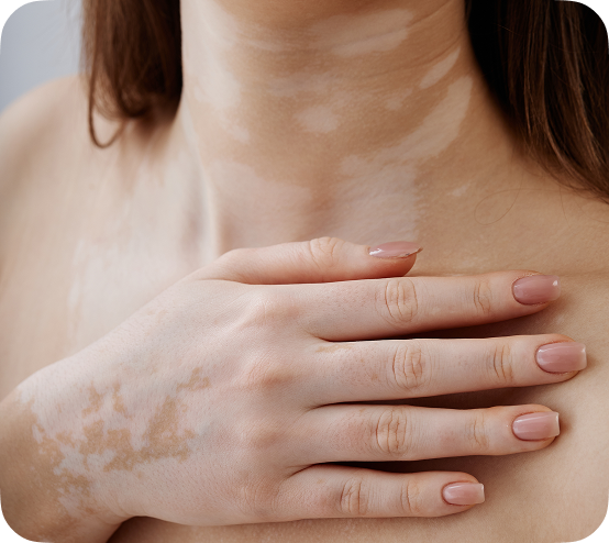 Nişantaşı’nda Excimer Lazer ile Vitiligo Tedavisi