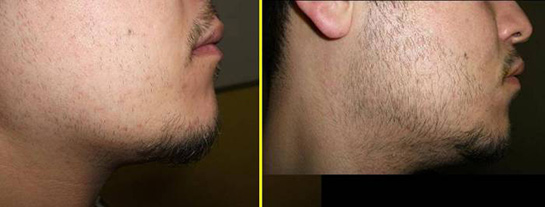 Sakal Çıkarıcı Minoxidil Losyon Nedir?